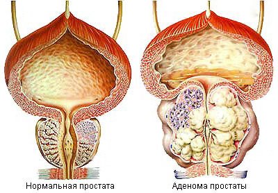 Prostatitning oldini olish usullari