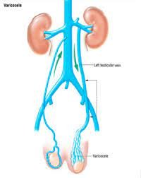 Varikosele - bu urug' tizimchasidagi venalarning kengayishi bo'lib